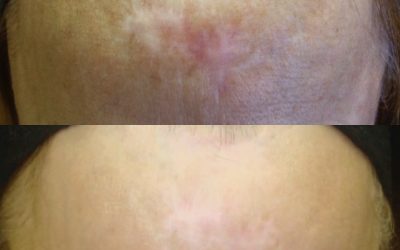 Skin Needling Scar Treatments Work