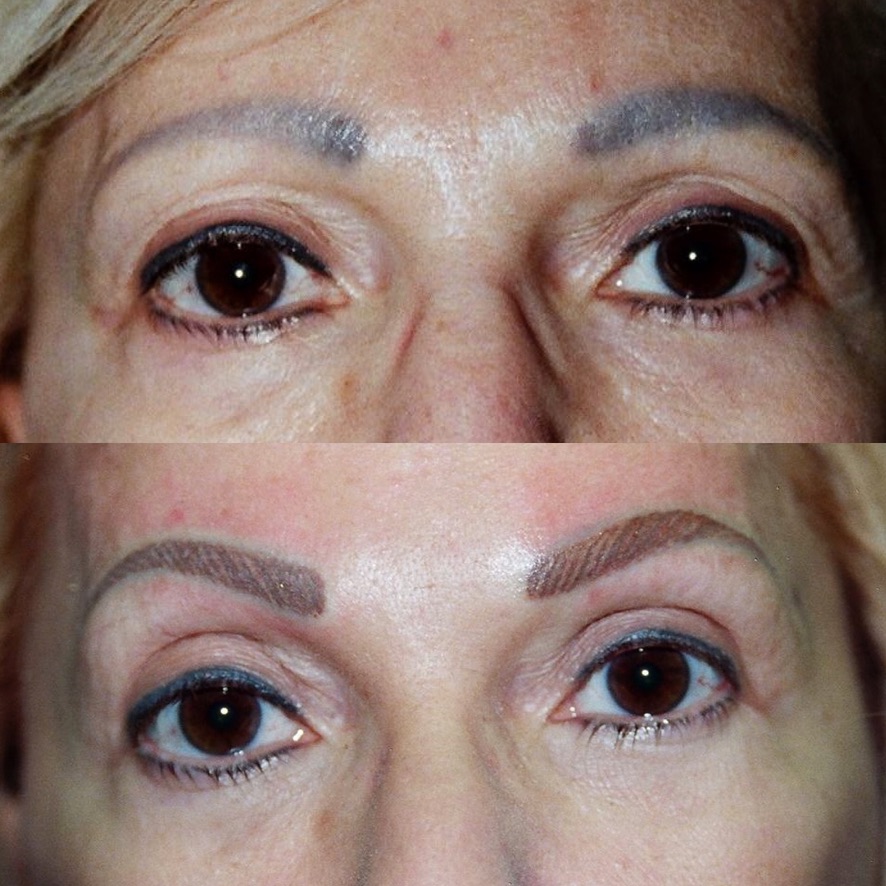Eyebrow Lightening & Re-Pigmentation