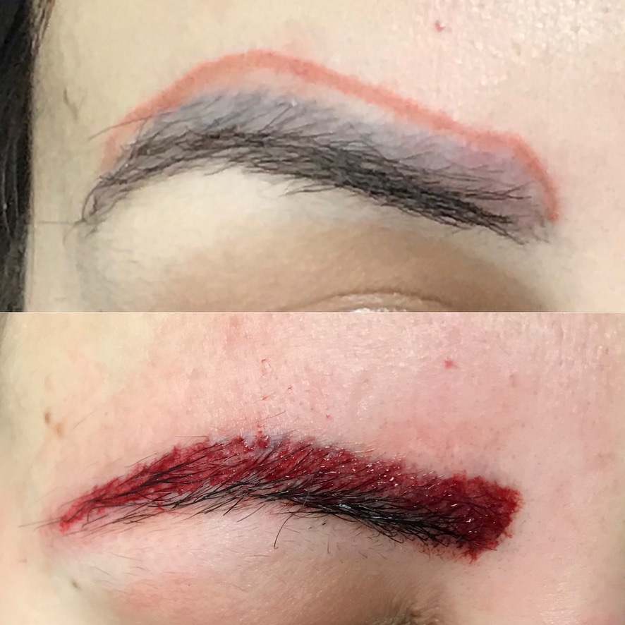 Before/After Brow Removal