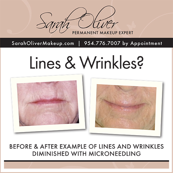 wrinkle-diminishing-skin-needling-treatment